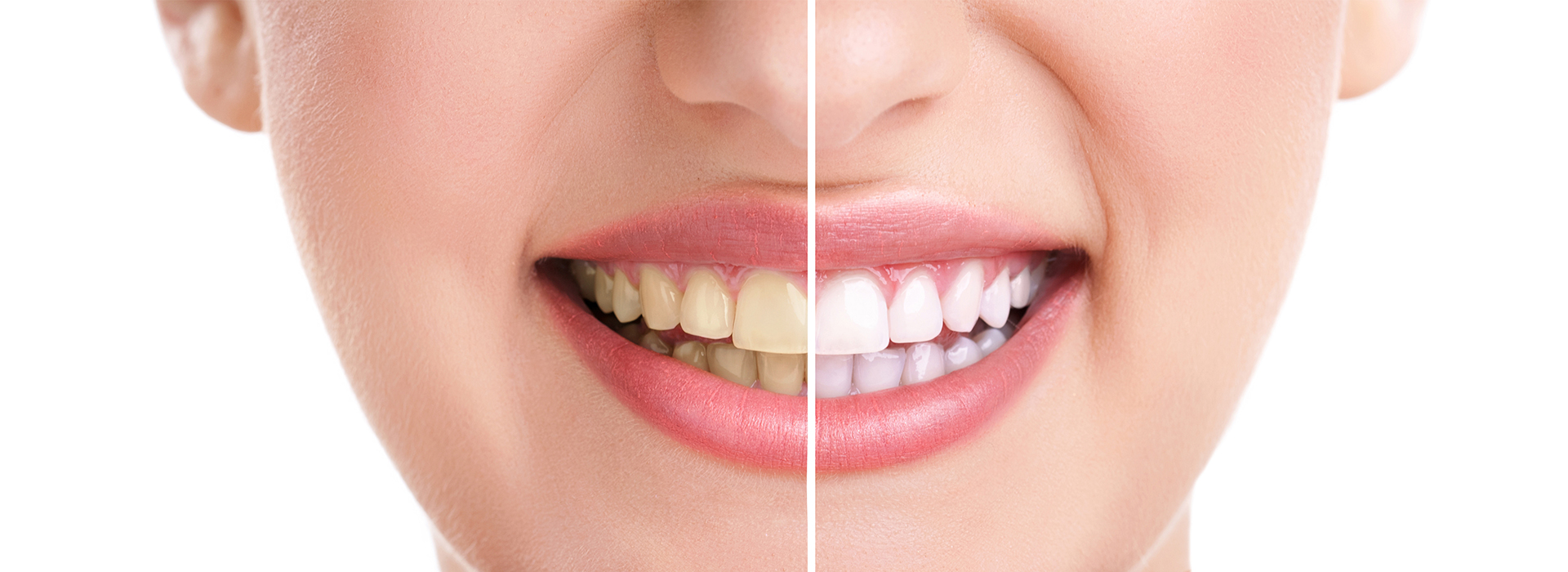 The image shows a close-up of a person s face with a focus on their teeth, which are being straightened using braces, indicated by the split view comparing before and after treatment.