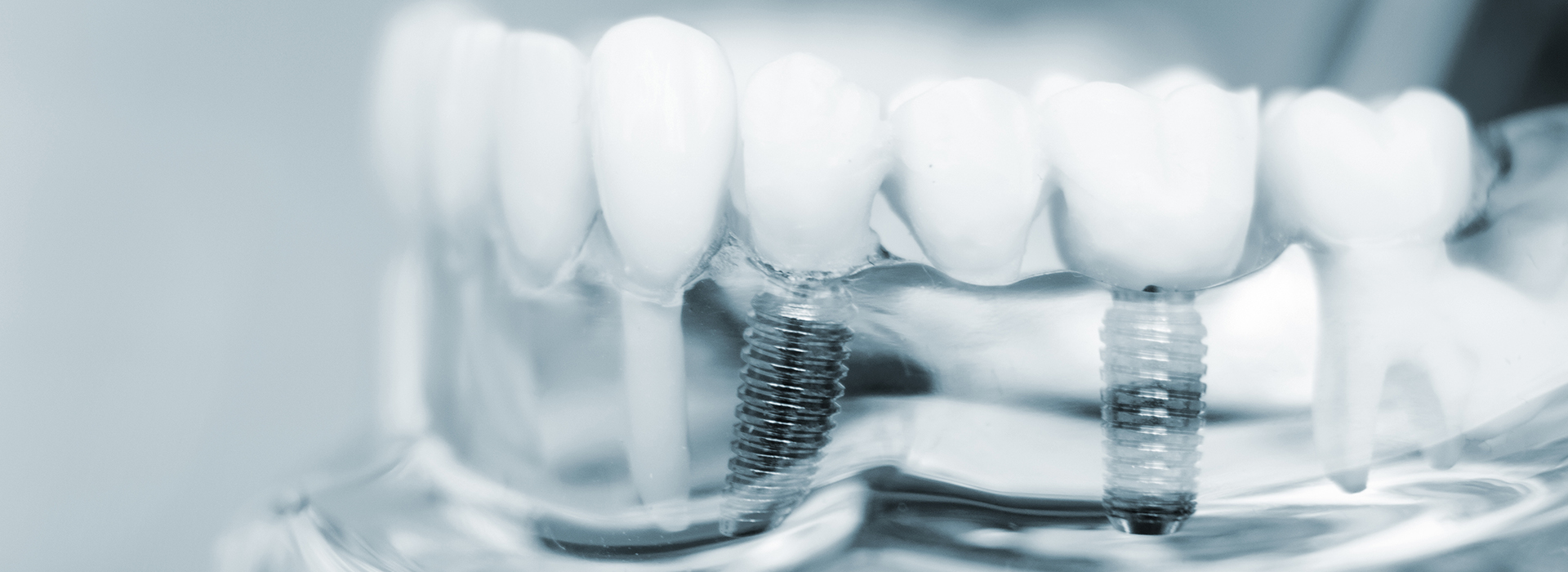 The image shows a close-up view of a dental implant with screws visible on its surface, set against a blurred background that appears to be a mouth with teeth.